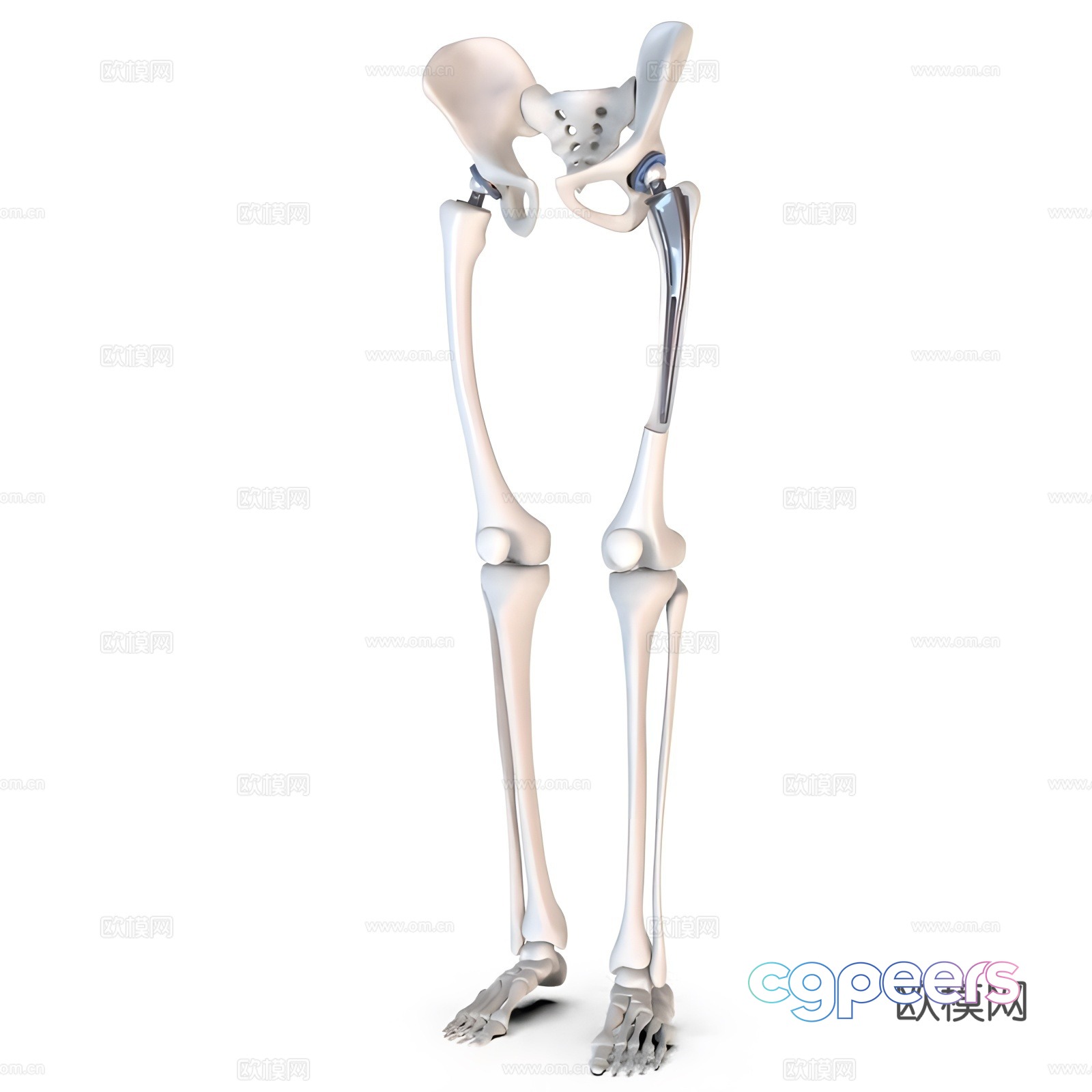 Hip replacement implant 3D model Hip replacement implant 3D model